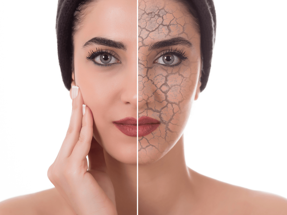 Dit Kan Je Het Beste Doen Als Je Last Hebt Van Een Droge Huid