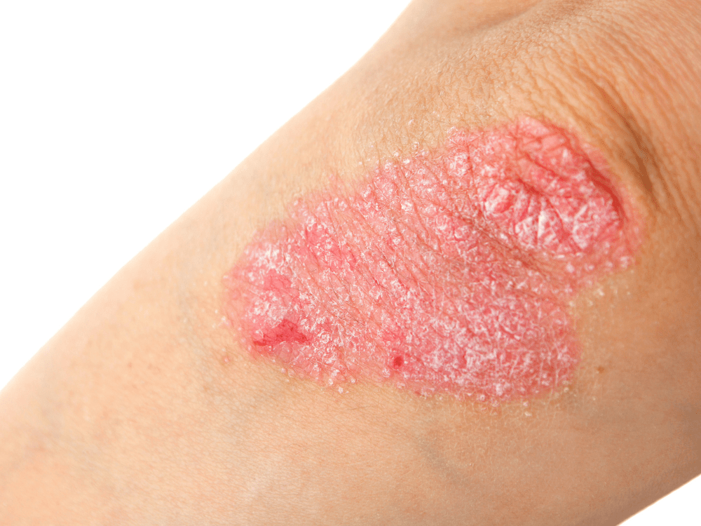 Wat Is Psoriasis En Hoe Kan Je Het Behandelen