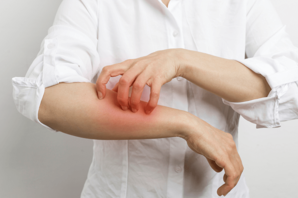 Wat Is Schurft Of Scabies