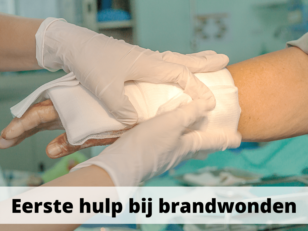 Wat Te Doen Bij Brandwonden