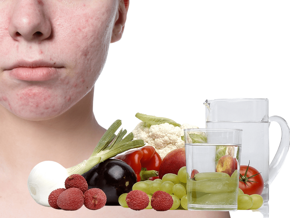 Wordt Acnè Veroorzaakt Door De Voeding Op Jouw Bord