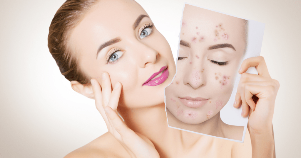 Acne, Wat Kan Je Doen Tegen Deze Vervelende Puistjes