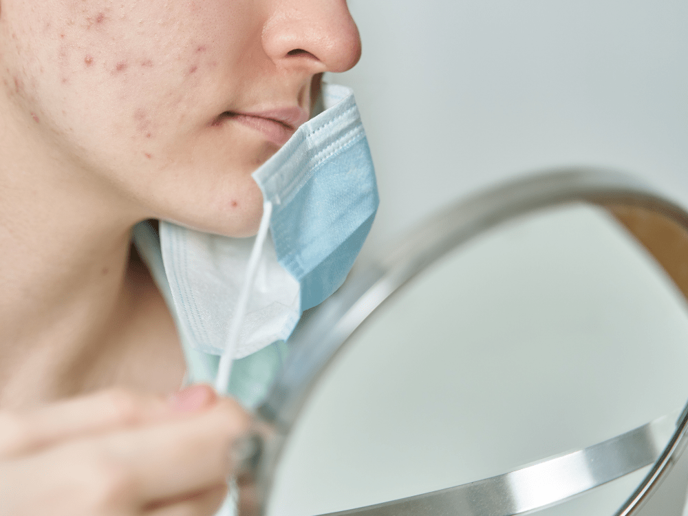 Ontdek Onze 5 Tips Om Maskne Te Voorkomen