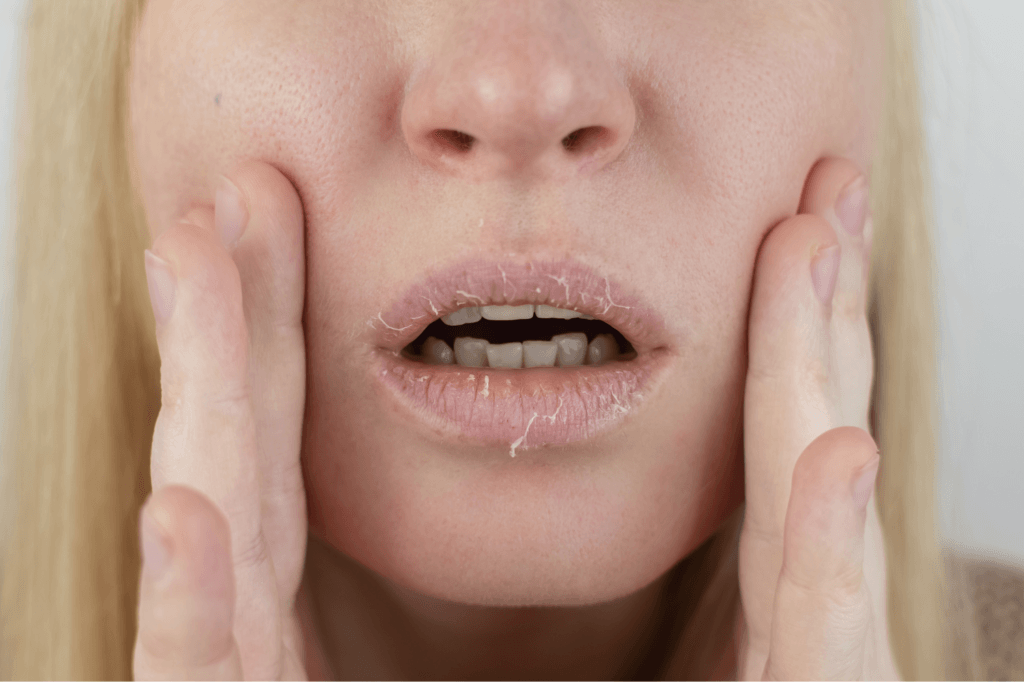 Tips Bij Droge Huid, Lippen En Handen In De Herfst