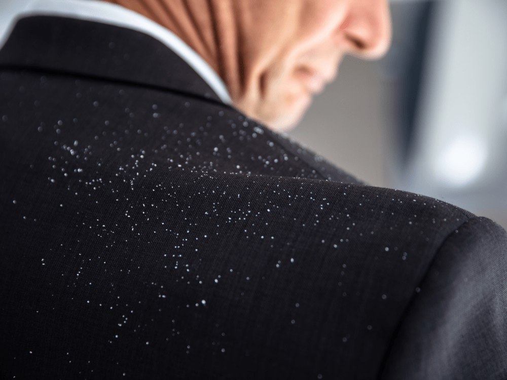 Wat Is Hoofdroos En Wat Kan Je Ertegen Doen