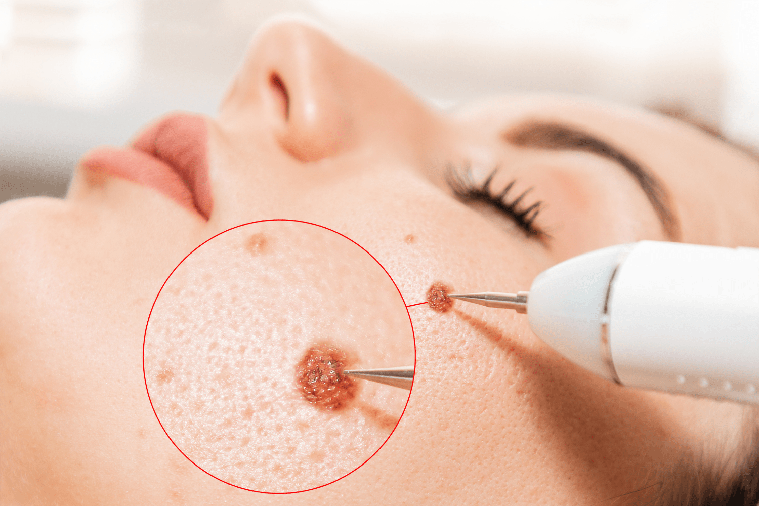 Wat Te Doen Tegen Pigmentvlekken