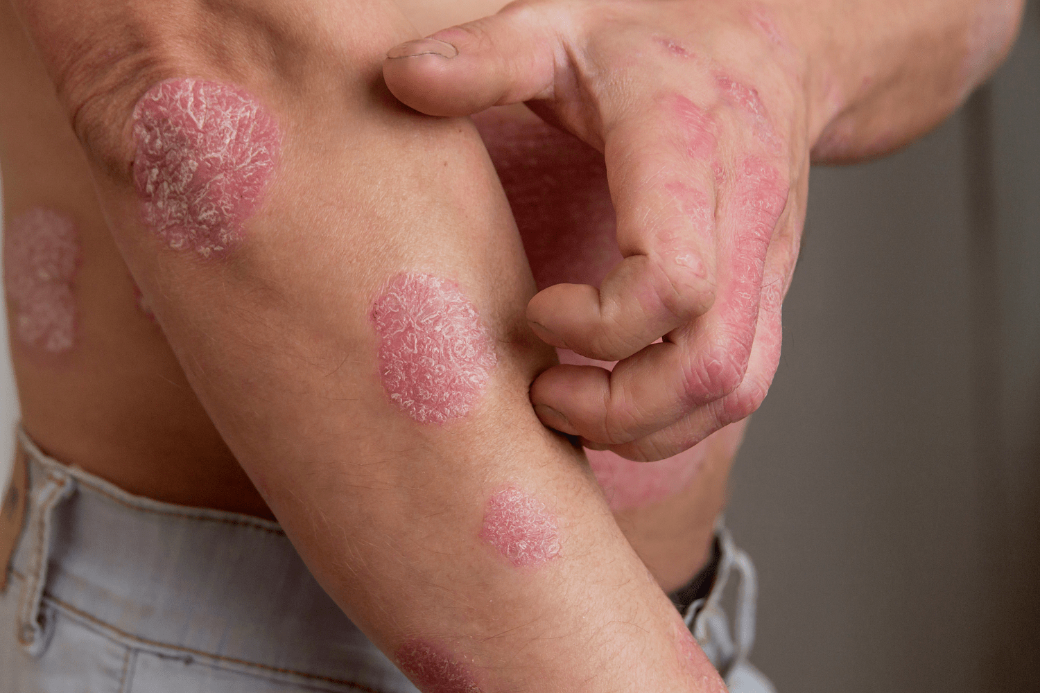 Wat Is Psoriasis En Hoe Kan Je Het Behandelen