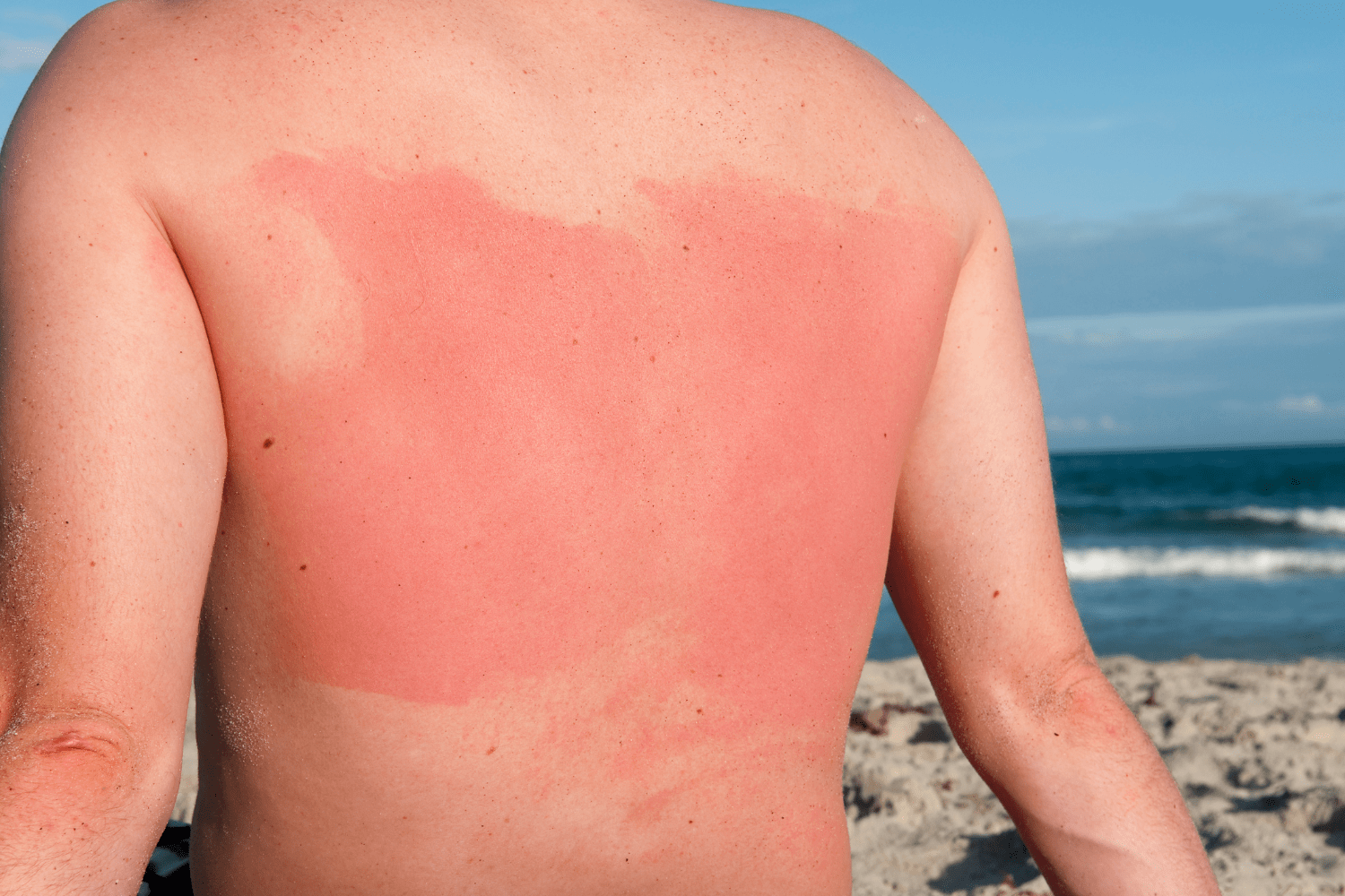 Zo Geniet Je Velig Van De Zomer En Voorkom Je Zonnebrand.
